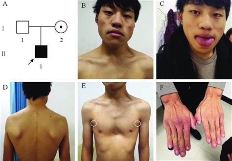 Pedigree and the patient. (A) Pedigree of the family with the ...