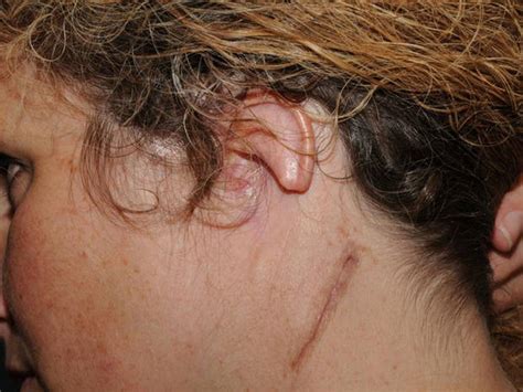 Ear reconstruction surgery (Graphic Photos) - CBS News