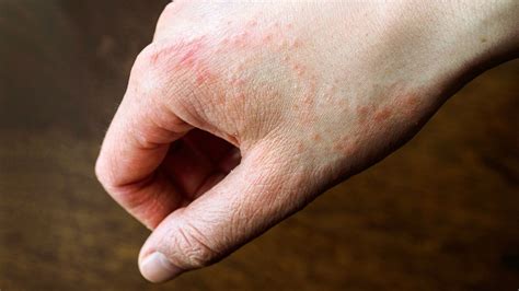 Viral Skin Rash Foot | Images and Photos finder