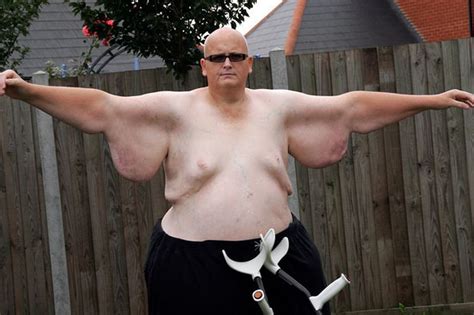 Former world's fattest man refused op to remove excess skin after 40st weight loss - Mirror Online