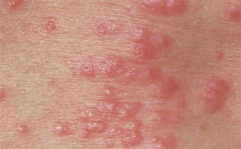 Rash on Scrotum, Testicles or Under Balls, Itchy Crotch Red Rash Causes ...