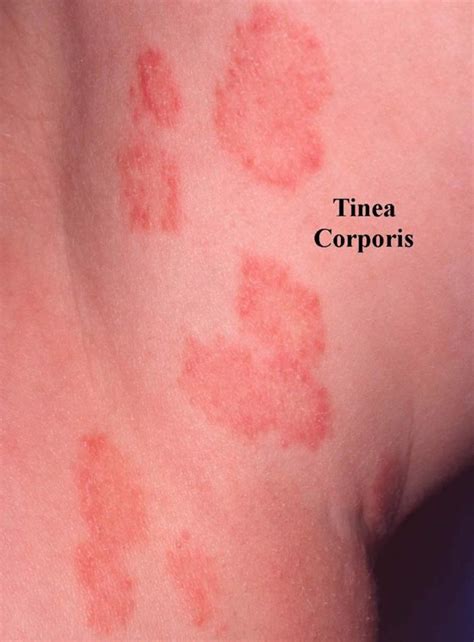 Ringworm Tinea Corporis Causes Risk Factors Signs Symptoms Diagnosis ...