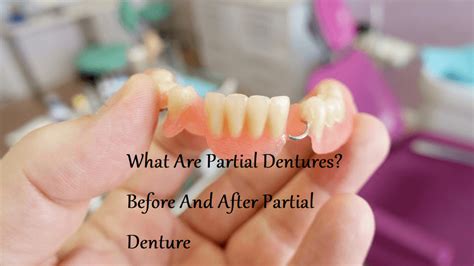 What Are Partial Dentures? Before And After Partial Dentures