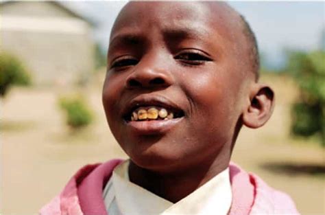 Dental Fluorosis in Kenya - causes and treatment - House of Dentistry