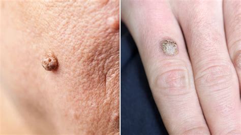 How to Remove Warts and Skin Tags Permanently | Power of Positivity