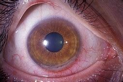 STOCK IMAGE, close-up of moorens ulcer a painful and rare peripheral ulceration of the cornea in ...