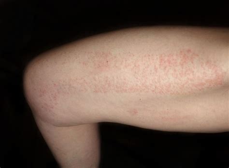 Red Spots on Skin: Causes, Diagnosis, and Treatments