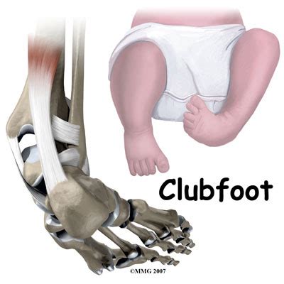 Talipes Equinovarus (Clubbed foot) ~ Anatomy for MSP