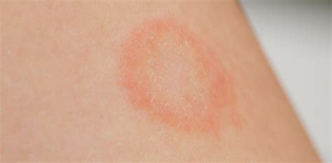 Ringworm Treatments | Mesa, AZ | Sagebrush Dermatology