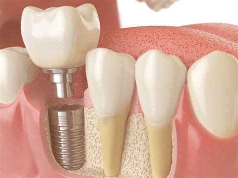 6 Side-Effects Of A Dental Implant Surgery