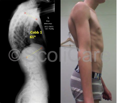 Case study: Kyphosis Bracing - Scoliosis Clinic UK - Treating Scoliosis ...