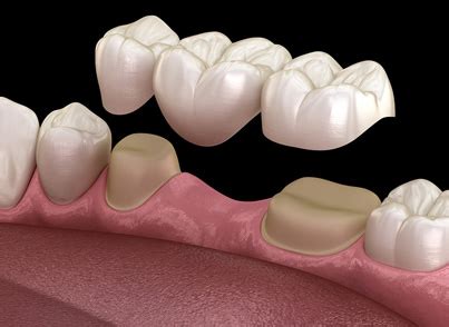 Porcelain Fixed Dental Bridges - Dentist in Hialeah Gardens, FL - RGD ...