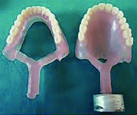 Flexible acrylic denture. | Download Scientific Diagram