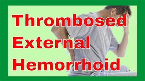 Thrombosed External Hemorrhoids - The Natural Cure