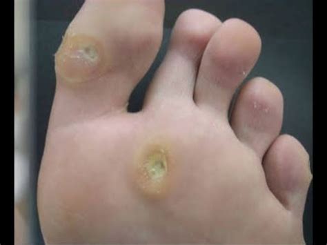 Psoriasis Under Toenails - The Complete Treatment Guide!