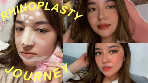 Filipino Nose Job Before And After