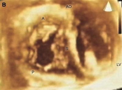 Frontiers | Three-dimensional echocardiography of the tricuspid valve