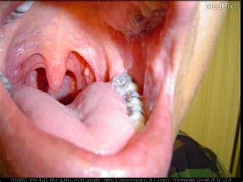 The elevated round pink area on the left tonsil appears to be approximately 4 mm in diameter. My ...