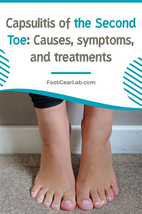 Capsulitis of the second toe causes symptoms and treatments – Artofit