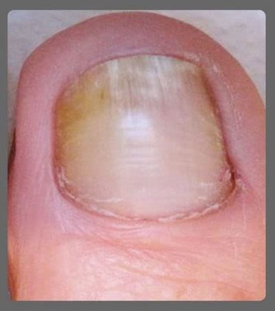 Kerasal Fungal Nail Renewal - Review & Case Study (2023)