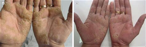 Type I Hereditary Punctate Keratoderma Associated With Widespread Lentigo Simplex and ...