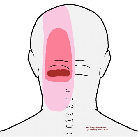 Headache at the Base of The Head - Integrative Works