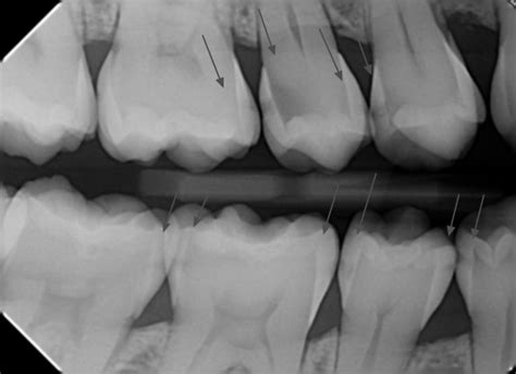 Bitewing xray with cavities 2 | Palms Dentist, Shirley Christchurch Dentists