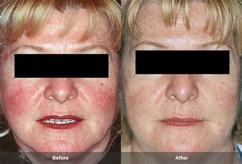 Acne Rosacea Before After