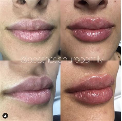 Restylane Versus Juvederm For Lips | Lipstutorial.org