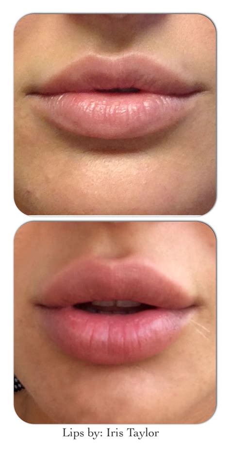 www.mybodytonic.com | Botox lips, Lip fillers, Lip fillers juvederm