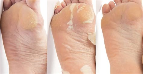 This viral foot peel mask is 50% off right now & the before and after ...