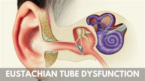 Eustachian Tube Dysfunction Remedies