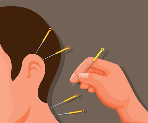 Chinese traditional acupuncture cartoon illustration vector 4599739 ...