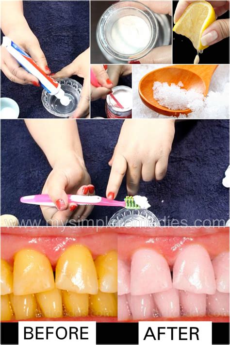 Pin on teeth whitening remedies