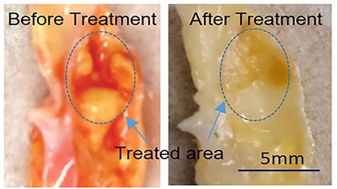 Ultrasound-assisted laser technique vaporizes | EurekAlert!