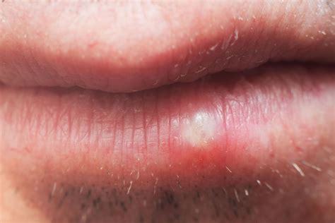 Mild Herpes Rash On Lips - Infoupdate.org