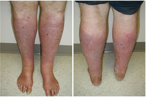 Chronic Venous Insufficiency Causes Of Development Sy - vrogue.co