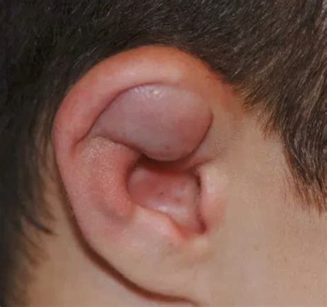 Ear Hematoma – Treatment : Emergency Care BC