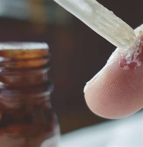 Salicylic acid wart removal: Effectiveness and how to use