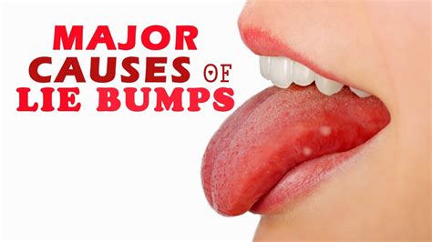 8 Major Causes of Lie Bumps - YouTube