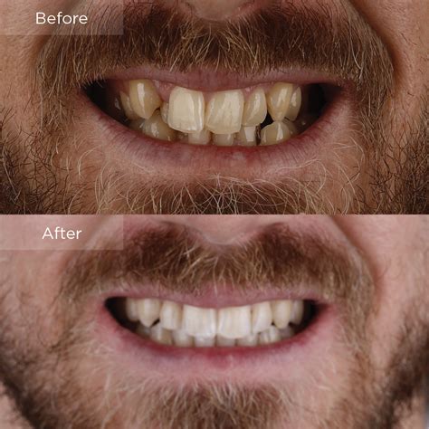 Invisalign Before And After Crowding