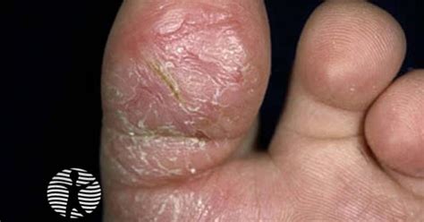 DermNet® - Juvenile plantar dermatosis image