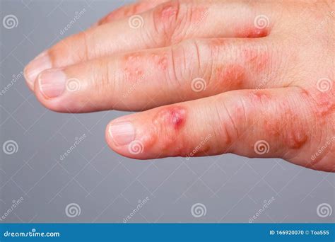 Shingles Is A Viral Infection That Causes A Painful Rash Stock Photo | CartoonDealer.com #152127510