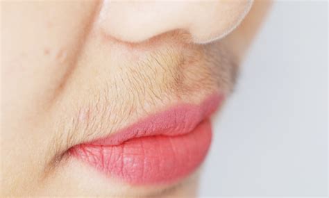 Hirsutism: Symptoms, Causes, Diagnosis, And Treatment - Tata 1mg Capsules