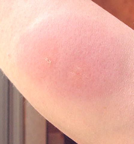 Mosquito Bite Allergy | New Health Guide