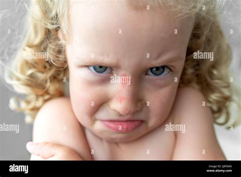 Close-up of the face of a sad child with a scratch on his nose Stock Photo - Alamy