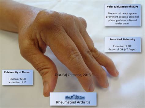 Rheumatoid Arthritis · RheumTutor