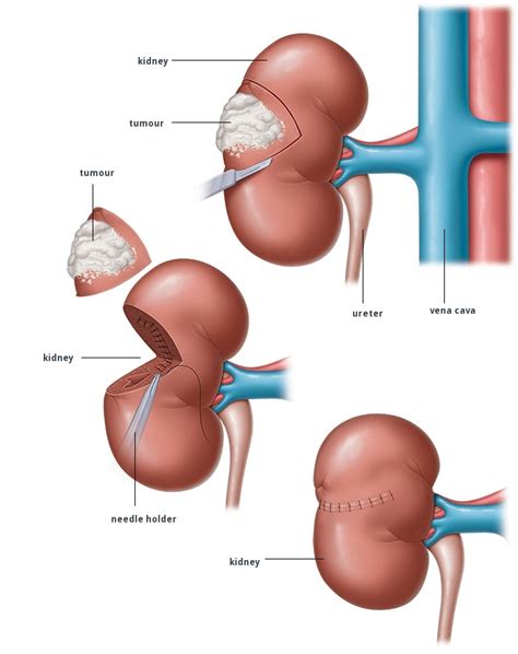 Radical Nephrectomy at best price in Raigad by IndianMedTrip Healthcare ...