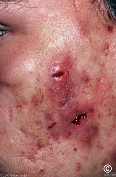 Rosacea Conglobata