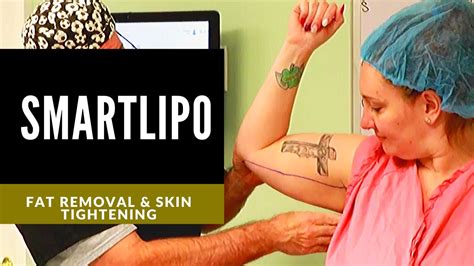 SmartLipo to the Arms | Smart Liposuction of the triceps by Cyanosure | Dr. Thomas E. Young, MD ...